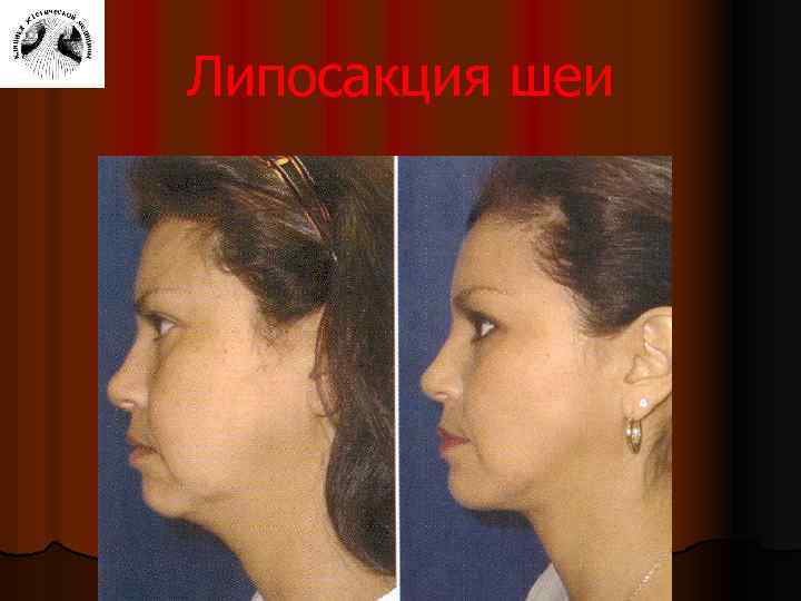 Липосакция шеи 