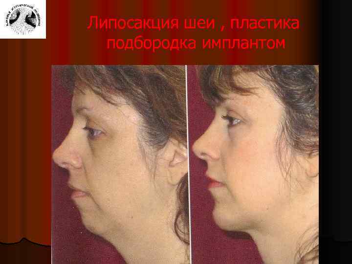 Липосакция шеи , пластика подбородка имплантом 