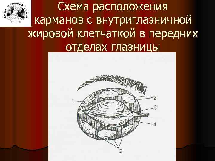 Схема расположения карманов с внутриглазничной жировой клетчаткой в передних отделах глазницы 