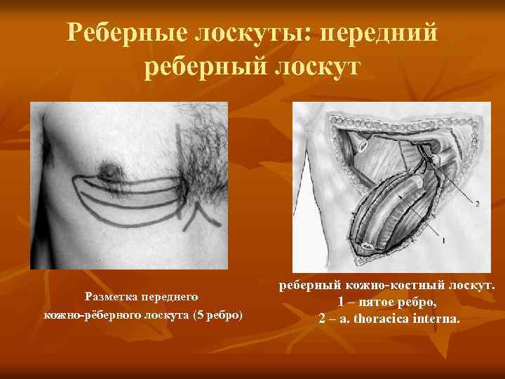 Реберные лоскуты: передний реберный лоскут Разметка переднего кожно-рёберного лоскута (5 ребро) реберный кожно-костный лоскут.
