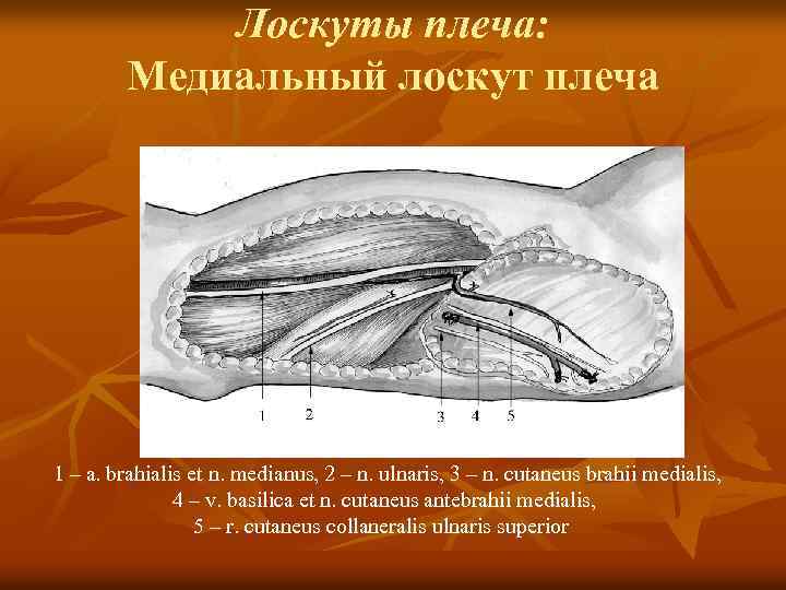 Лоскуты плеча: Медиальный лоскут плеча 1 – a. brahialis et n. medianus, 2 –