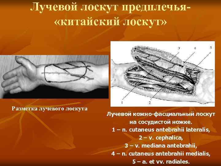 Лучевой лоскут предплечья «китайский лоскут» Разметка лучевого лоскута Лучевой кожно-фасциальный лоскут на сосудистой ножке.
