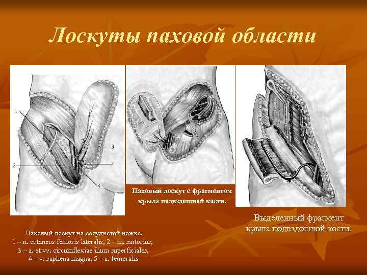 Лоскуты паховой области Паховый лоскут с фрагментом крыла подвздошной кости. Паховый лоскут на сосудистой