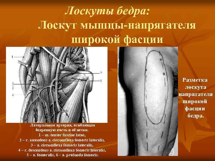 Лоскуты бедра: Лоскут мышцы-напрягателя широкой фасции Разметка лоскута напрягателя широкой фасции бедра. Латеральная артерия,