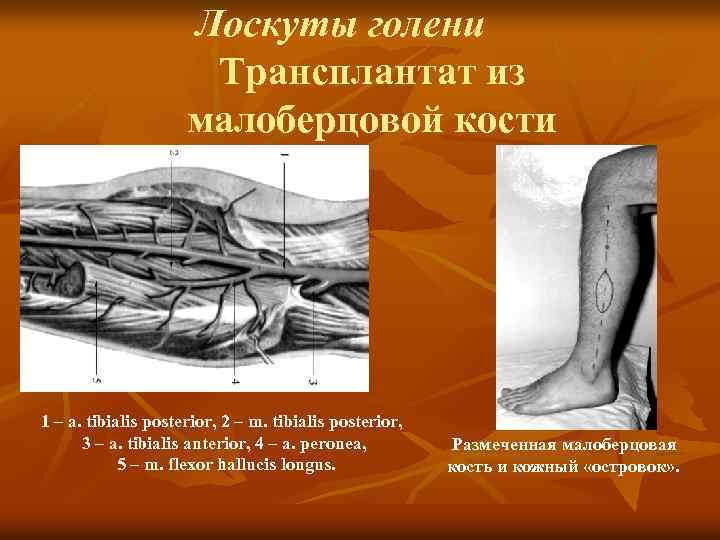Лоскуты голени Трансплантат из малоберцовой кости 1 – a. tibialis posterior, 2 – m.