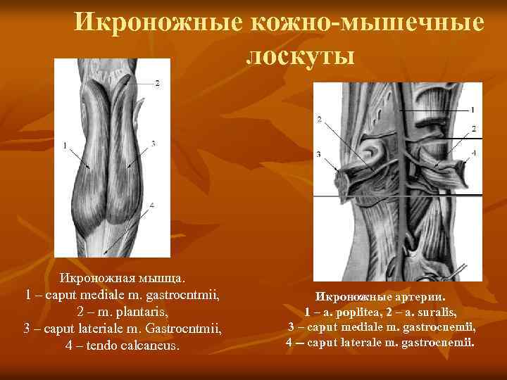 Икроножные кожно-мышечные лоскуты Икроножная мышца. 1 – caput mediale m. gastrocntmii, 2 – m.