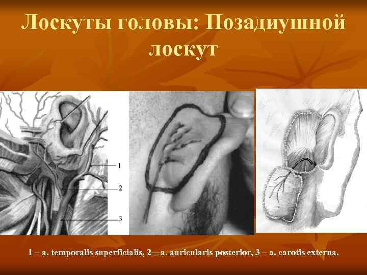Лоскуты головы: Позадиушной лоскут 1 – a. temporalis superficialis, 2—a. auricularis posterior, 3 –
