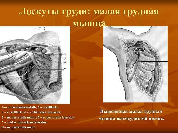 Лоскуты груди: малая грудная мышца 1— a. toracoacromialis, 2 – a. axillaris, 3 –