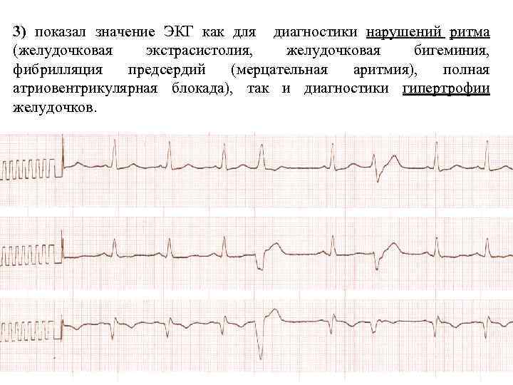 Экстрасистолия карта вызова