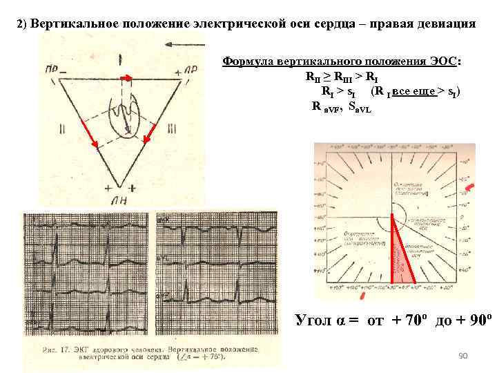 2) Вертикальное положение электрической оси сердца – правая девиация Формула вертикального положения ЭОС: RII