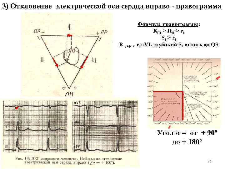 3) Отклонение электрической оси сердца вправо - правограмма Формула правограммы: RIII > RII >