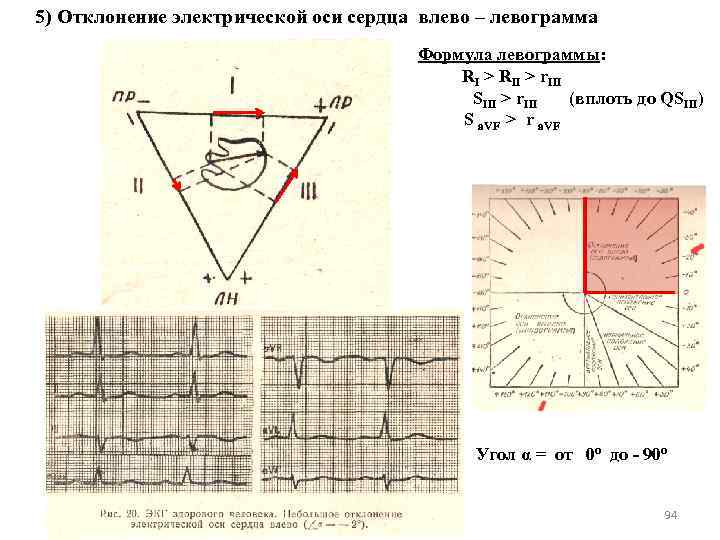 5) Отклонение электрической оси сердца влево – левограмма Формула левограммы: RI > RII >