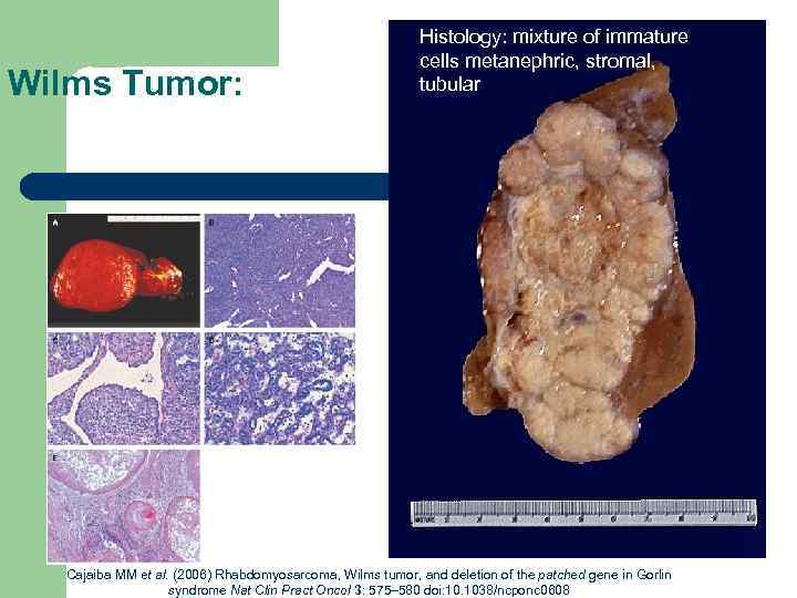 Wilms Tumor: Histology: mixture of immature cells metanephric, stromal, tubular Cajaiba MM et al.