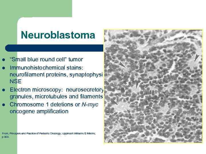 Neuroblastoma l l “Small blue round cell” tumor Immunohistochemical stains: neurofilament proteins, synaptophysin, NSE