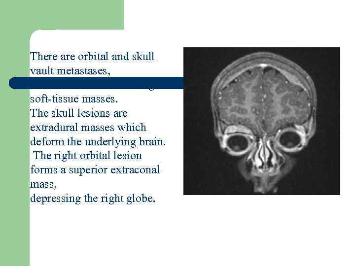 There are orbital and skull vault metastases, with associated enhancing soft-tissue masses. The skull