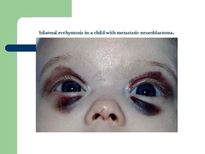 bilateral ecchymosis in a child with metastatic neuroblastoma. 