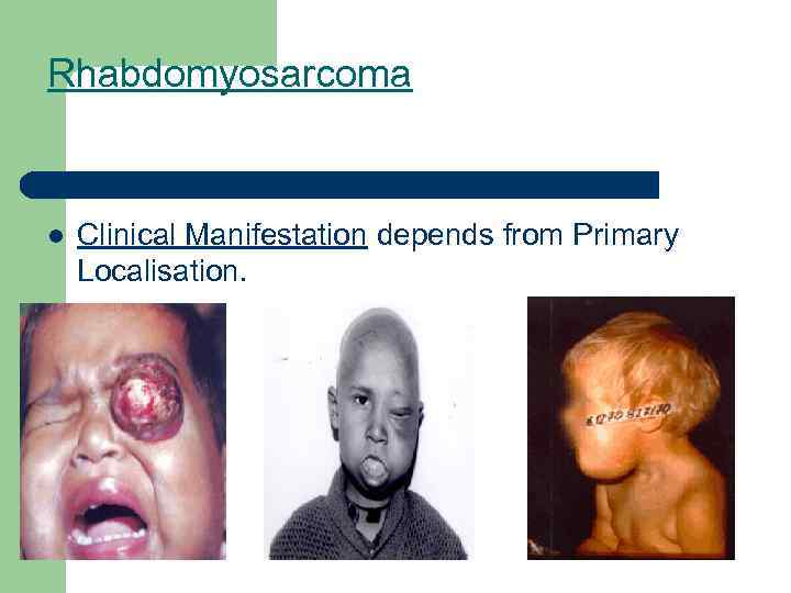 Rhabdomyosarcoma l Clinical Manifestation depends from Primary Localisation. 