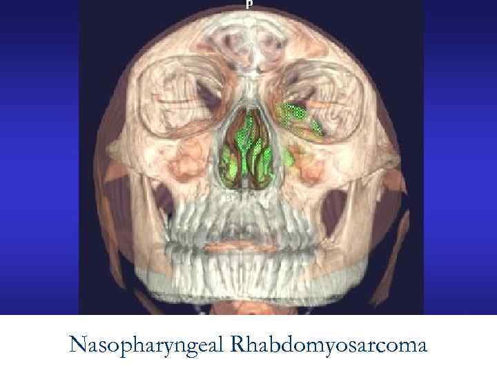 Nasopharyngeal Rhabdomyosarcoma 