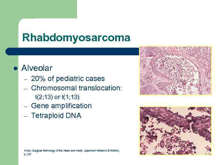 Rhabdomyosarcoma l Alveolar – – 20% of pediatric cases Chromosomal translocation: t(2; 13) or