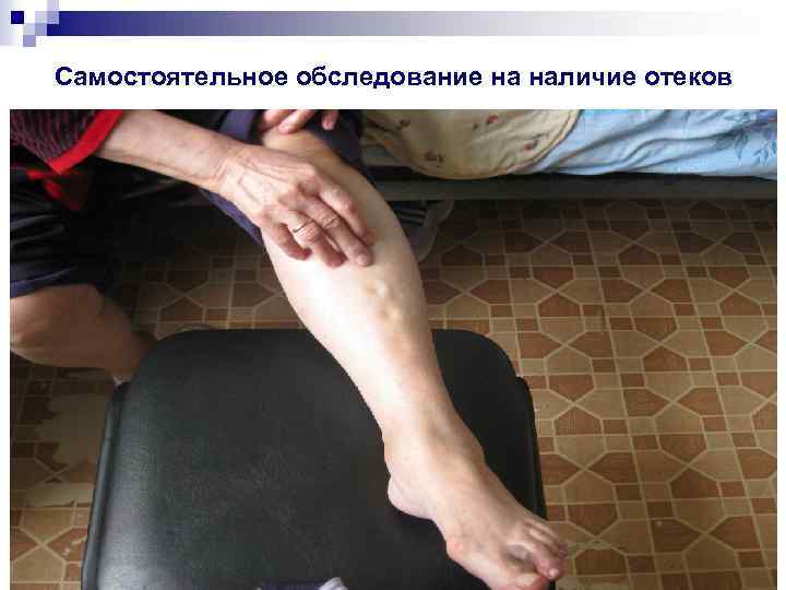 Самостоятельное обследование на наличие отеков 
