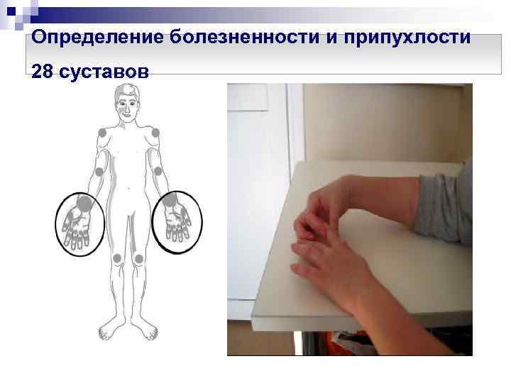 Определение болезненности и припухлости 28 суставов 