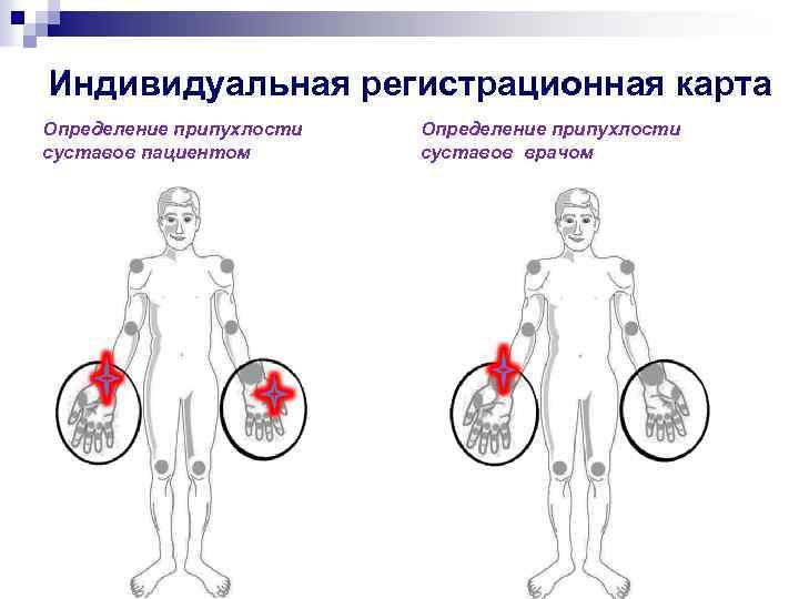 Индивидуальная регистрационная карта Определение припухлости суставов пациентом Определение припухлости суставов врачом 
