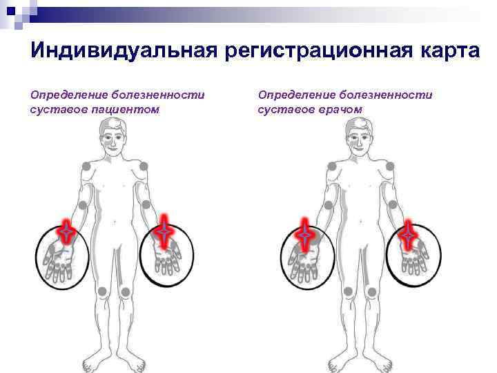 Индивидуальная регистрационная карта Определение болезненности суставов пациентом Определение болезненности суставов врачом 