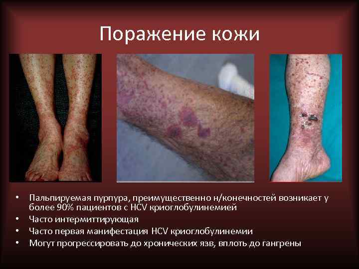 Поражение кожи • Пальпируемая пурпура, преимущественно н/конечностей возникает у более 90% пациентов с HCV