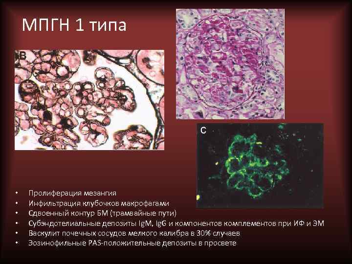 МПГН 1 типа • • • Пролиферация мезангия Инфильтрация клубочков макрофагами Сдвоенный контур БМ