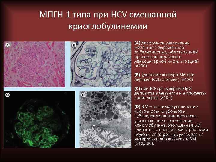 МПГН 1 типа при HCV смешанной криоглобулинемии • (A) диффузное увеличение мезангия с выраженной