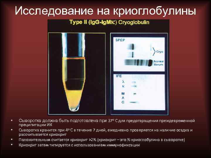 Исследование на криоглобулины • • Сыворотка должна быть подготовлена при 37 о C для