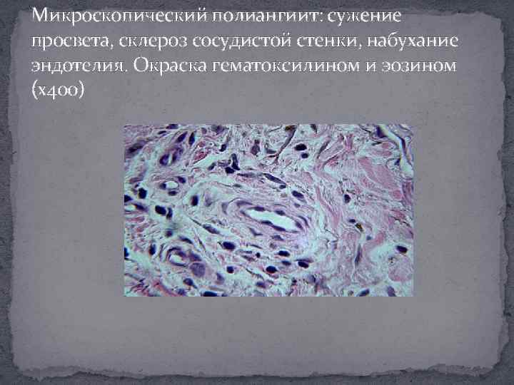 Микроскопический полиангиит: сужение просвета, склероз сосудистой стенки, набухание эндотелия. Окраска гематоксилином и эозином (х400)