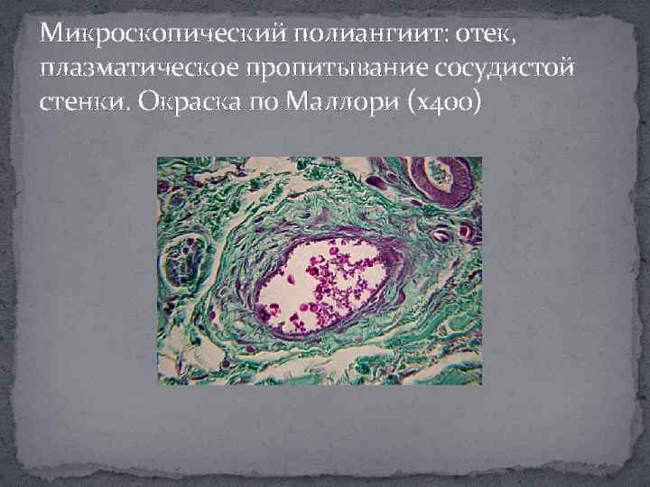 Микроскопический полиангиит: отек, плазматическое пропитывание сосудистой стенки. Окраска по Маллори (х400) 