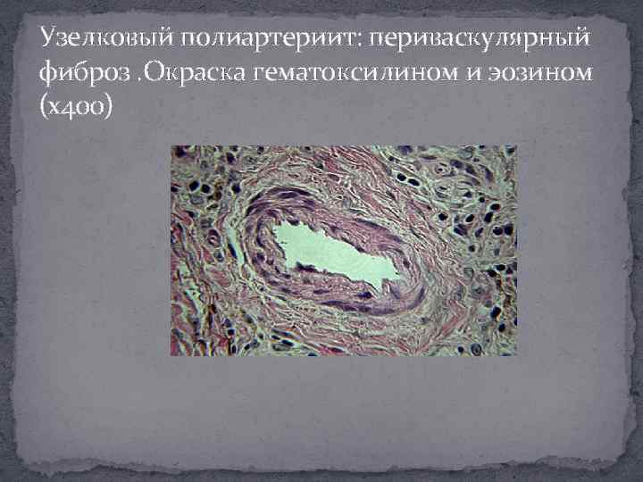 Узелковый полиартериит: периваскулярный фиброз. Окраска гематоксилином и эозином (х400) 