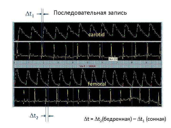 Dt 1 Последовательная запись carotid femoral Dt 2 Dt = Dt 2(бедренная) – Dt