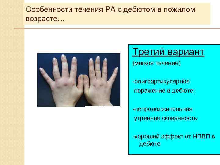 Течение ревматоидного артрита. Варианты течения ревматоидного артрита. Дебют ревматоидного артрита. Ревматический артрит Возраст. Течение ревматоидного артрита бывает.