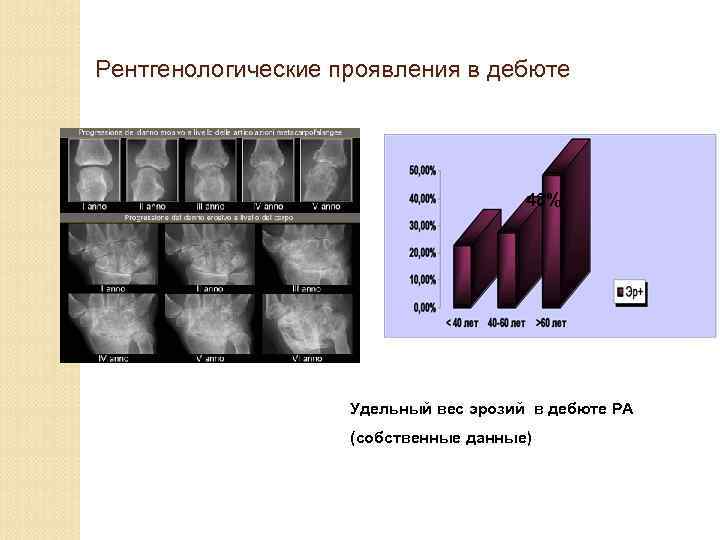 Рентгенологические проявления в дебюте 48% Удельный вес эрозий в дебюте РА (собственные данные) 