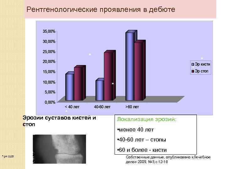 Рентгенологические проявления в дебюте * * * Эрозии суставов кистей и стоп * Локализация