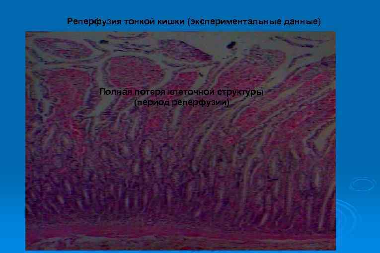 Реперфузия тонкой кишки (экспериментальные данные) Полная потеря клеточной структуры (период реперфузии) 