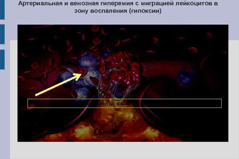 Артериальная и венозная гиперемия с миграцией лейкоцитов в зону воспаления (гипоксии) Протеолитические ферменты, свободные