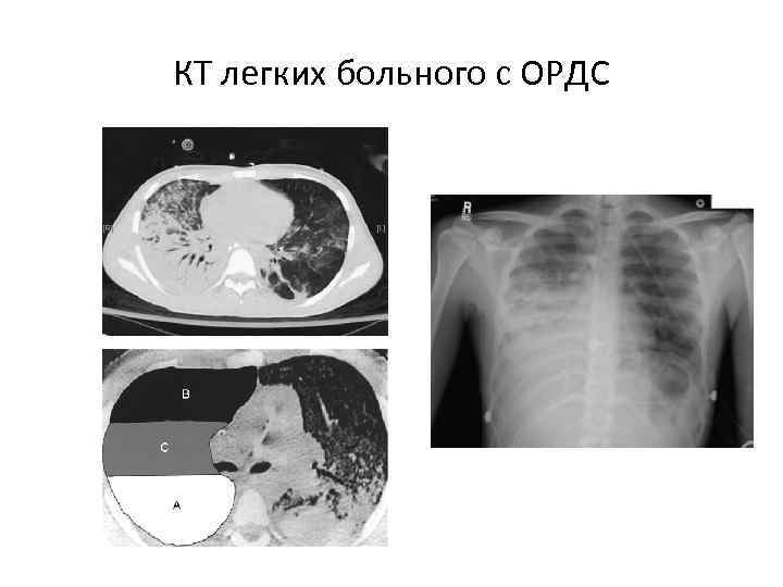 Поствоспалительные изменения в легких на кт