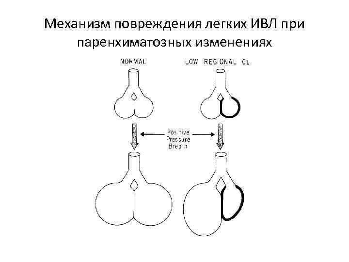 Механизм повреждения легких ИВЛ при паренхиматозных изменениях 