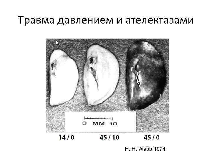 Травма давлением и ателектазами H. H. Webb 1974 