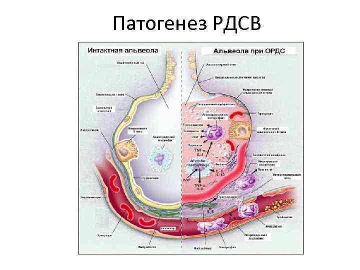 Патогенез РДСВ 