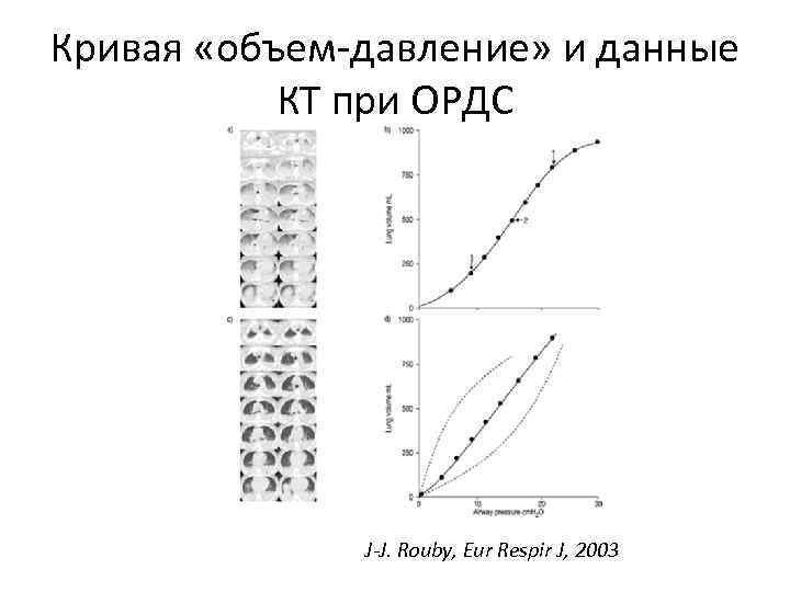 Кривая «объем-давление» и данные КТ при ОРДС J-J. Rouby, Eur Respir J, 2003 