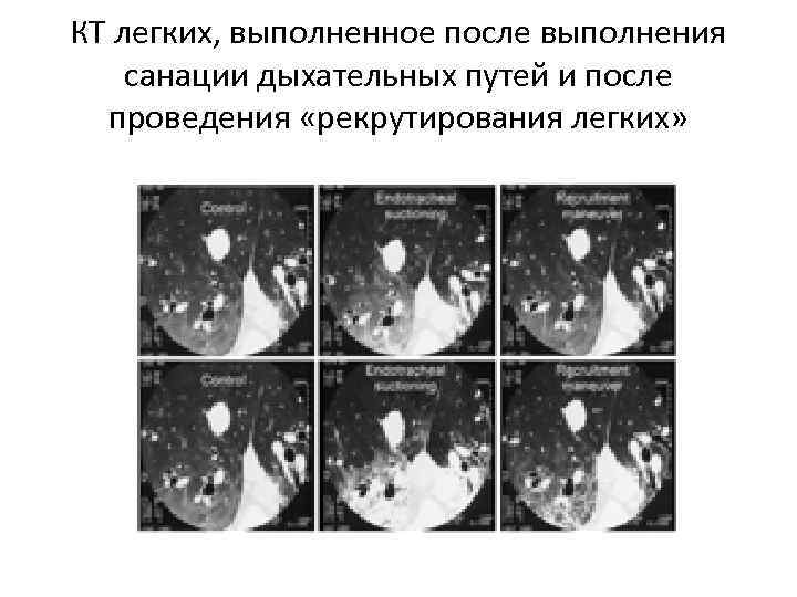КТ легких, выполненное после выполнения санации дыхательных путей и после проведения «рекрутирования легких» 