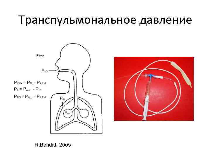 Транспульмональное давление R. Benditt, 2005 