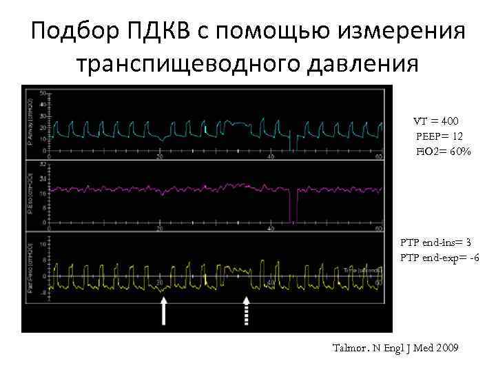 Подбор ПДКВ с помощью измерения транспищеводного давления VT = 400 PEEP= 12 Fi. O