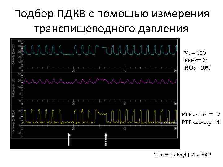 Подбор ПДКВ с помощью измерения транспищеводного давления VT = 320 PEEP= 24 Fi. O
