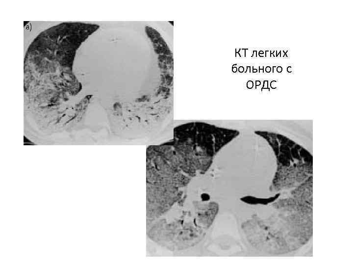КТ легких больного с ОРДС 